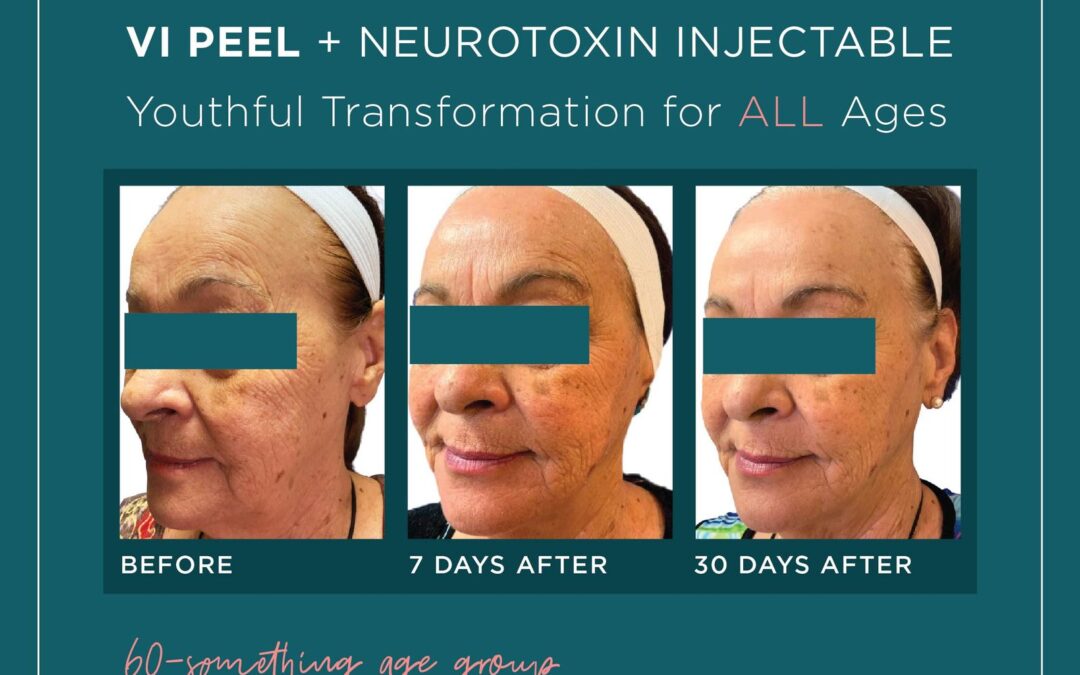5 Reasons Why You Shouldn’t Botox Without a VI Peel (AKA The ToxBooster Treatment)