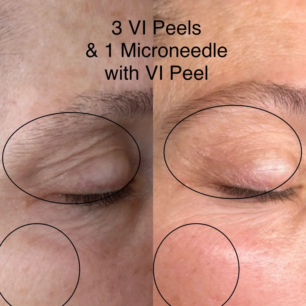 VI-Peel1