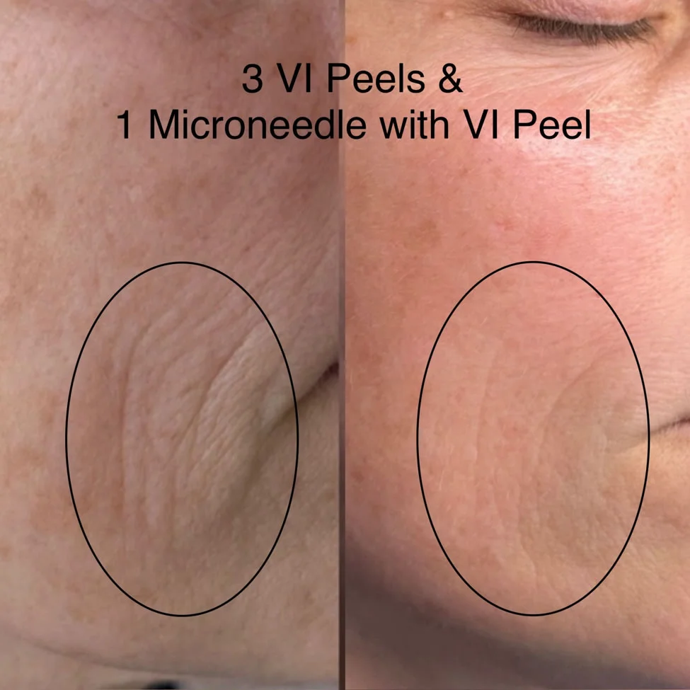VI-Peel2